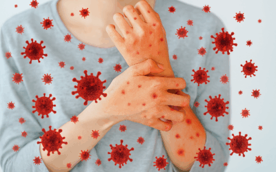 Dermatomiositis anti-MDA5+ tras infecciones por Sars-Cov-2: una revisión sistemática