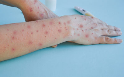 Alerta Epidemiológica: Circulación de casos confirmados de sarampión por Argentina