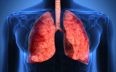La fibrosis pulmonar post-Covid-19 se caracteriza por anomalías en las vías respiratorias y niveles elevados de proteína secretora celular 16