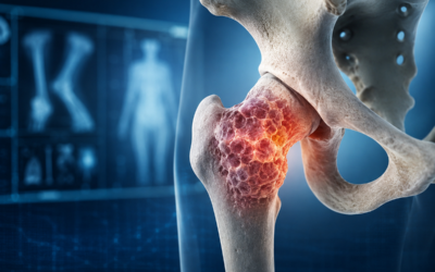 Oncología Ortopédica: tumores musculoesqueléticos